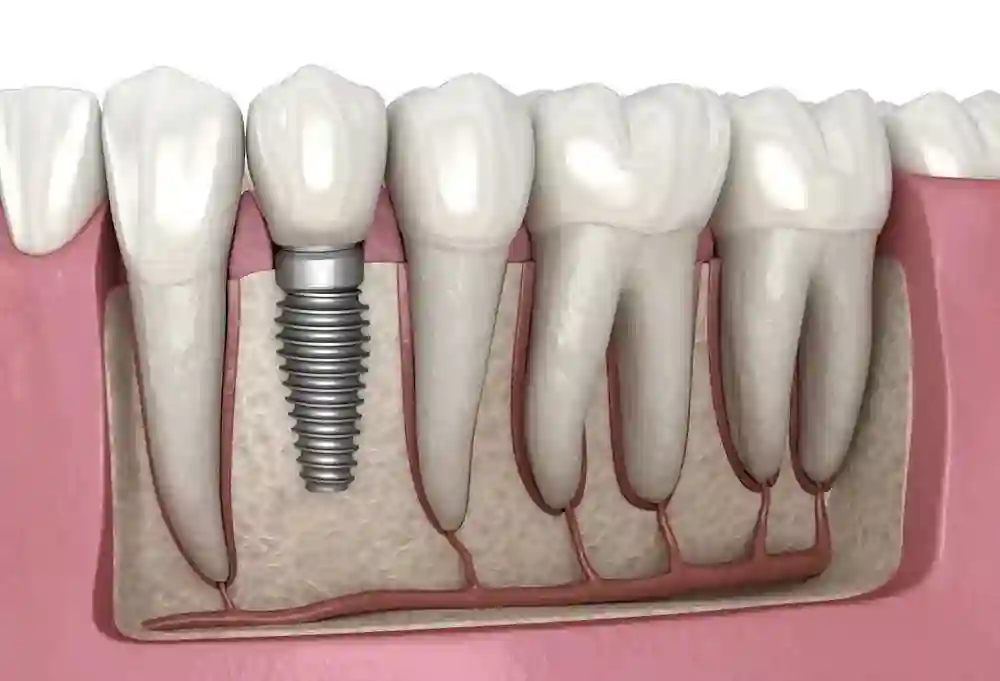 Root Canal